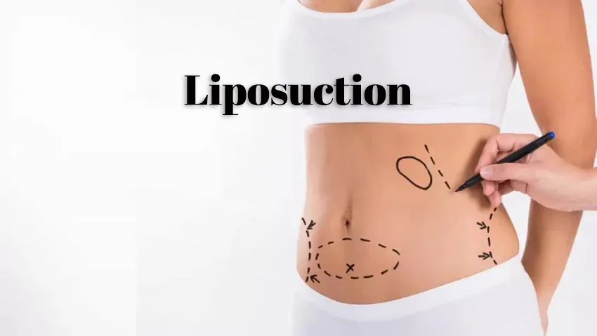 Liposakşın, Yağ aldırma, Liposakşın ameliyatı konya