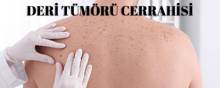 Deri tümörü cerrahisi konya