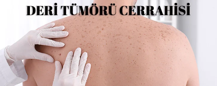 Deri tümörü cerrahisi konya