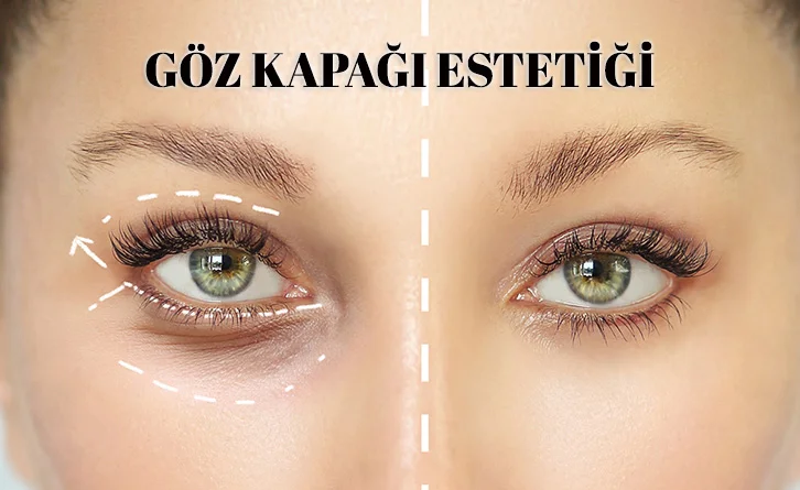 Göz Kapağı Estetistiği
