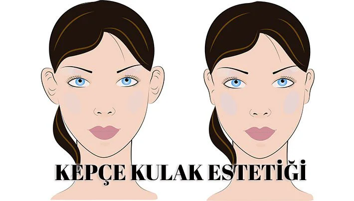 Kepçe Kulak Estetiği
