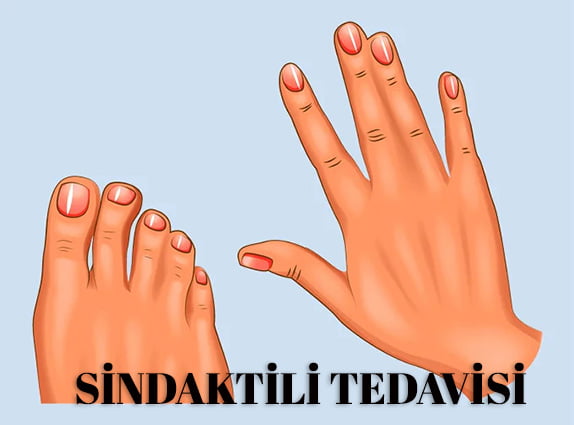 Sindaktili